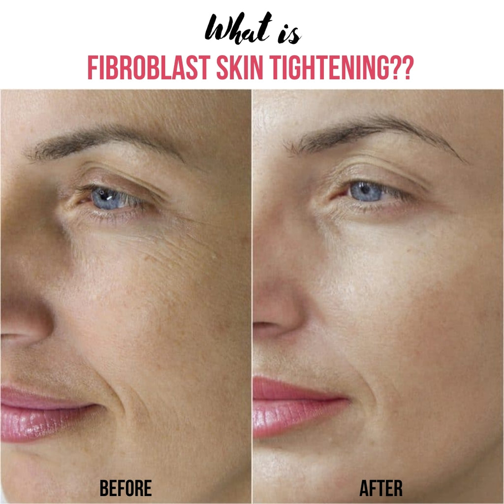 What is Fibroblast Plasma Skin Tightening?